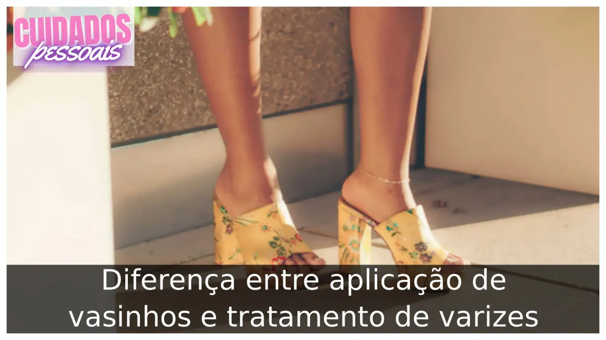 Diferença entre aplicação de vasinhos e tratamento de varizes Diferença entre aplicação de vasinhos e tratamento de varizes